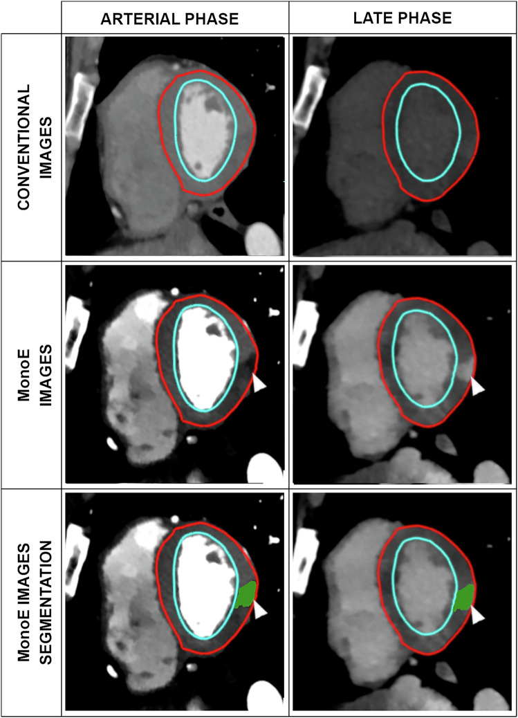 Appearance of myocarditis lesions on spectral CT arterial acquisitions and correlation with edema on MRI.