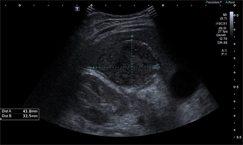 When appendicitis mimics a liver abscess: diagnostic challenges in pediatric surgery.