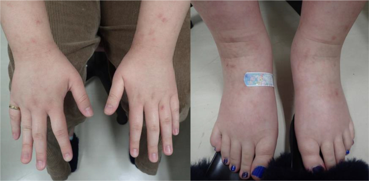 Seasonal occurrence of nonepisodic angioedema with eosinophilia: A case series of 12 patients.