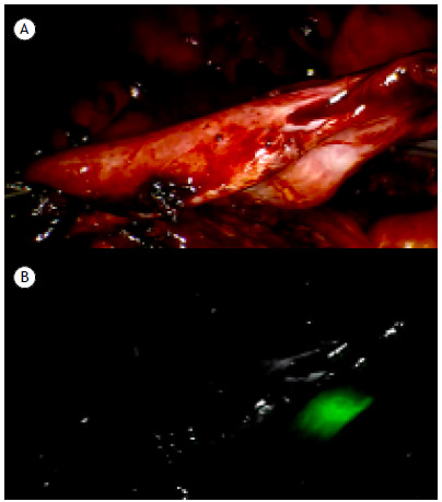 Indocyanine green used in association with a surgical hemostatic agent as a fiducial marker to reduce overflow during robot-assisted thoracic surgery.