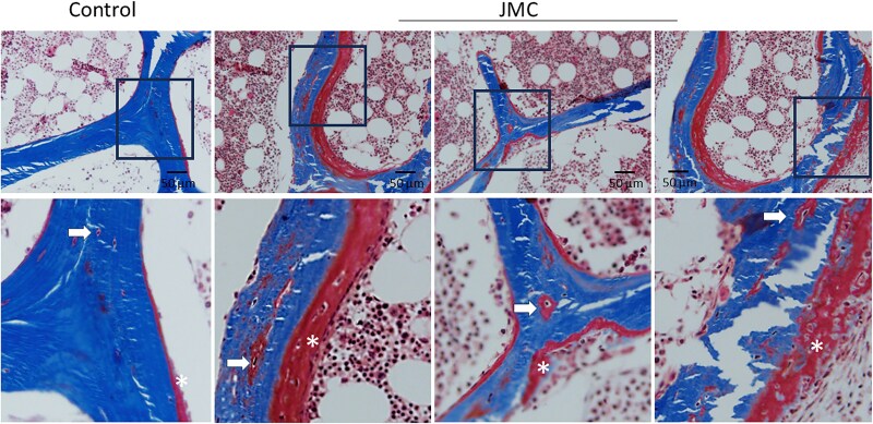 Jansen's Disease: Bone Abnormalities Beyond Chondrodysplasia.