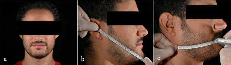 Using injectable Platelet-Rich fibrin to improve recovery after impacted lower third molar extraction: a randomized controlled clinical trial.