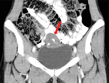 A Rare Case of Primary Signet Ring Cell Carcinoma of the Urinary Bladder in a Young Woman.