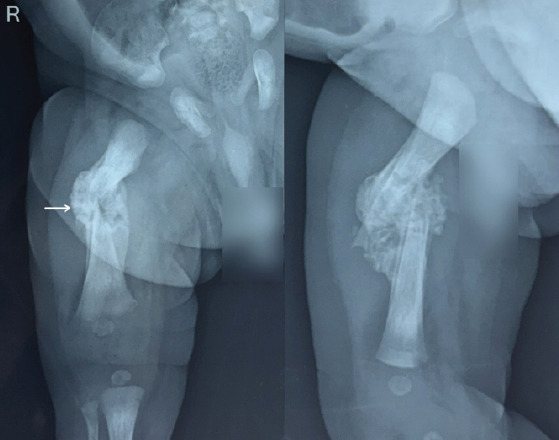 Obstetric Neonatal Femur Fracture During Emergency Cesarean Section for Breech: A Case Report.