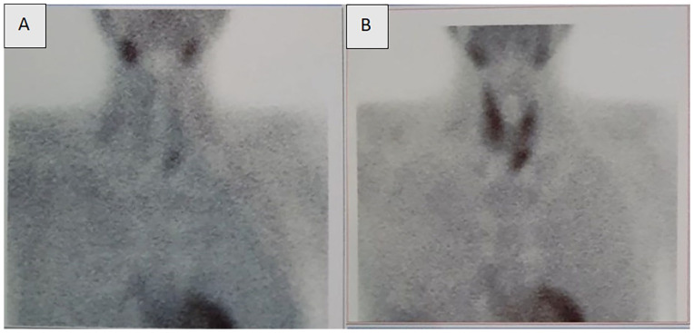 Concurrent Hyperparathyroidism and Wilson's Disease in a Patient With Methanol Toxicity: A Rare Case Report.