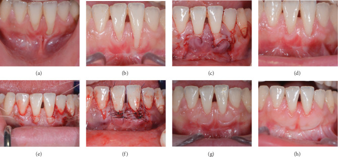 Retreatment of Gingival Recessions: Rationale and Definition Case Series Follow-Up.