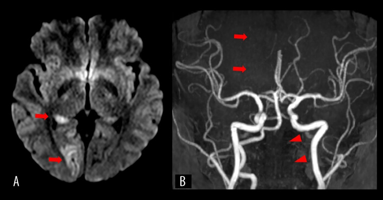 Vertebral Artery Dissection Induced by Fitness Video Game Exercise: A Case Report.
