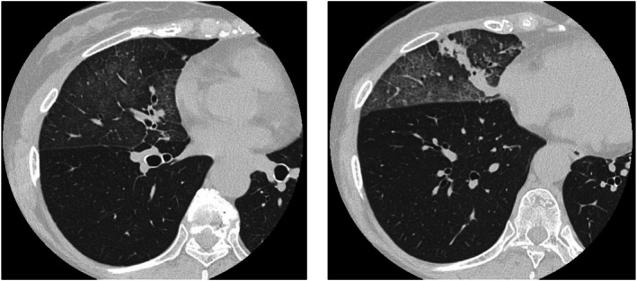 The Paradox of Metachronous Lipoid Pneumonia.