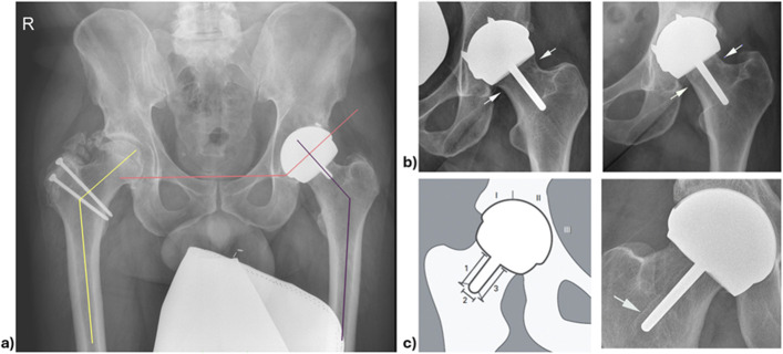 Survivorship of Cemented Versus Cementless Metal on Metal Hip Resurfacing: A Match-Cohort Analysis at Minimum 5 Years.