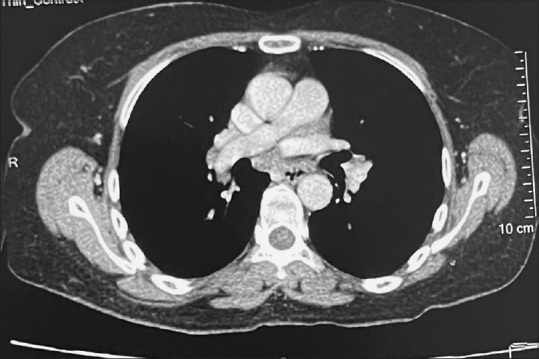 Morpheaform Sarcoidosis - A Very Rare Presentation of Sarcoidosis with a Brief Review of Literature.