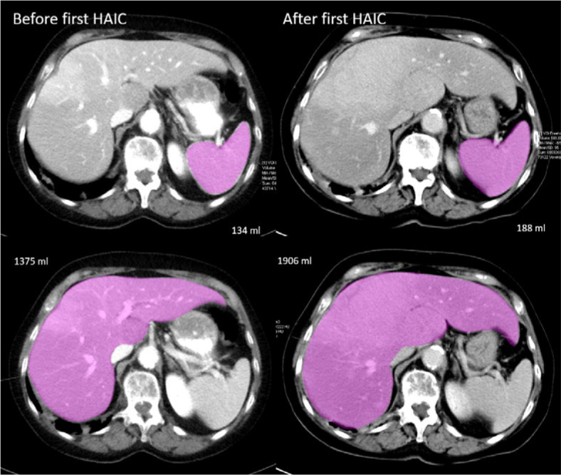 Does volume change of the spleen correlate with the therapy response in uveal melanoma patients with liver metastases undergoing hepatic artery infusion chemotherapy?
