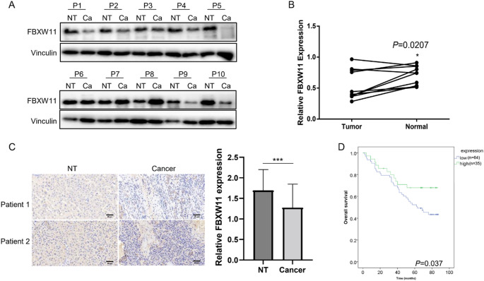 FBXW11 inhibits tumorigenesis by ubiquitinating YB1 in hepatocarcinoma.