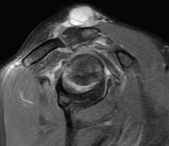 A Silent Shoulder of Plentiful Pathology: An Uncommon Presentation of Acromioclavicular Ganglion Cyst.