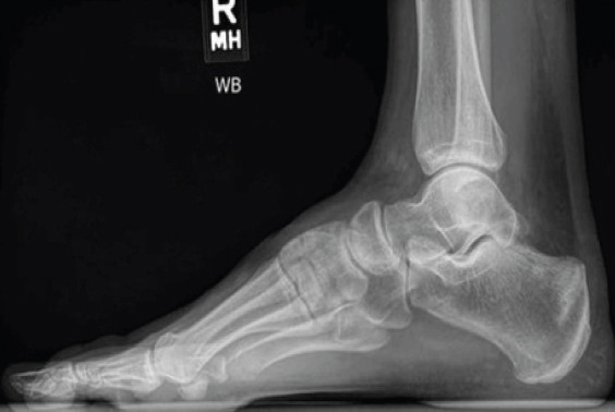 Calcaneus and Traumatic Stress Fracture.