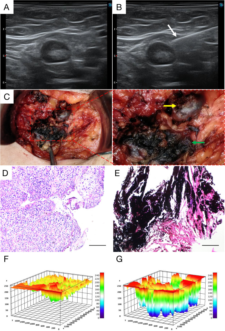 Peri-Lymph Node Tattooing with Carbon Nanoparticles Suspension: A Novel Strategy for Targeted Axillary Dissection in Breast Cancer.