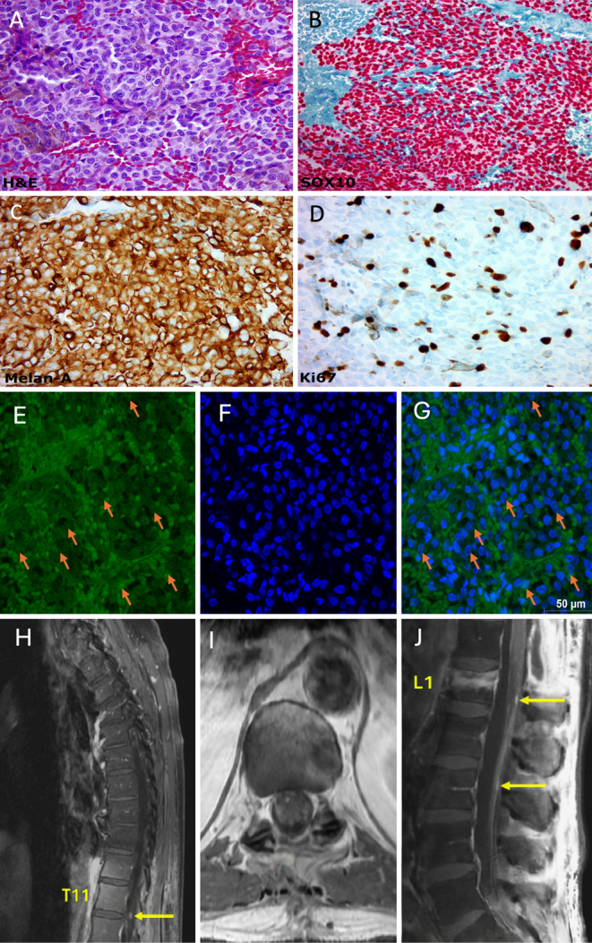 GNAQ mutation in primary spinal melanoma: illustrative case.