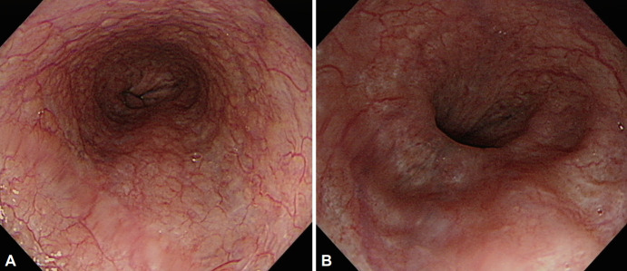 A Case of Black Esophagus in a Patient Presenting With Dyspnea.