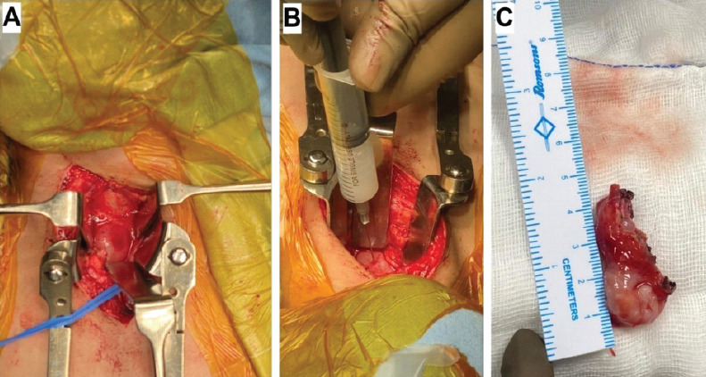 Isolated Anterior Extradural Enterogenous Cyst of the Thoracic Spine Mimicking an Anterior Thoracic Meningocele: A Case Report.