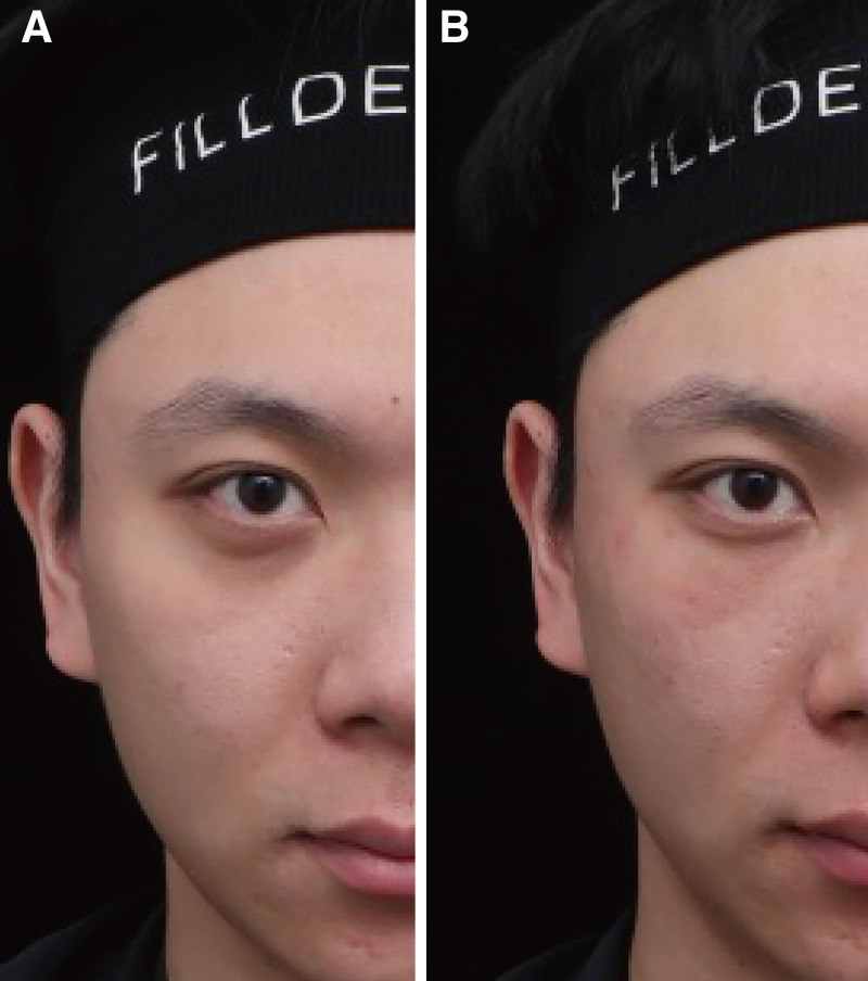 Collagen Use in Periorbital Rejuvenation for Chinese Patients: The Restoration Injection for Optimal Rejuvenation Technique.