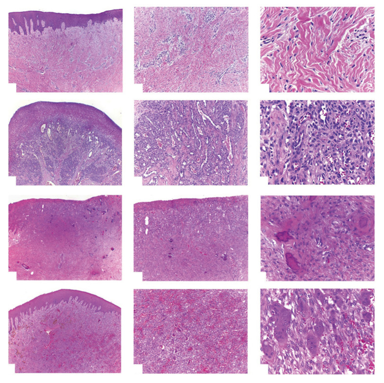 Epulis: A Narrative Review of Epidemiology, Clinical Features, Pathogenesis, and Management.