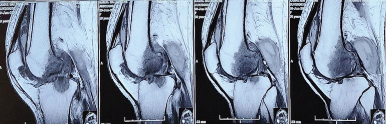 Total Knee Arthroplasty in Tuberculous Arthritis of the Knee - A Case Report.