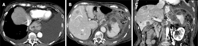 Transpapillary drainage of pancreatic fluid leakage <i>via</i> a rigid trans-tumoral tract using a drill dilator: A case report.