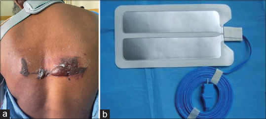 Second-Degree Burn From a Grounding Pad of Surgical Device During Surgery of Left Clavicle Fracture - Untoward, Unexpected Event.