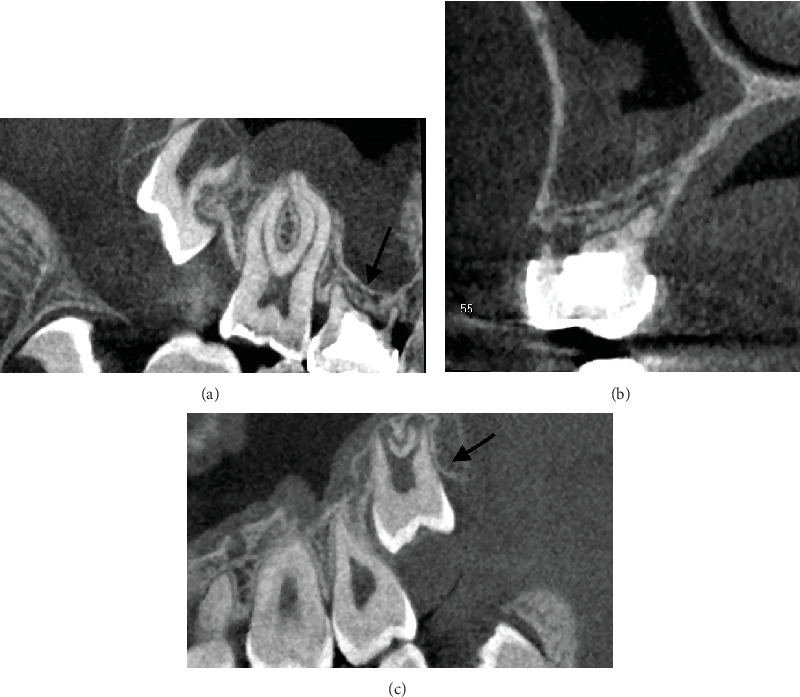 Combining a Sinus Augmentation With Tooth Transplantation When Replacing a Missing Premolar in a Young Patient.