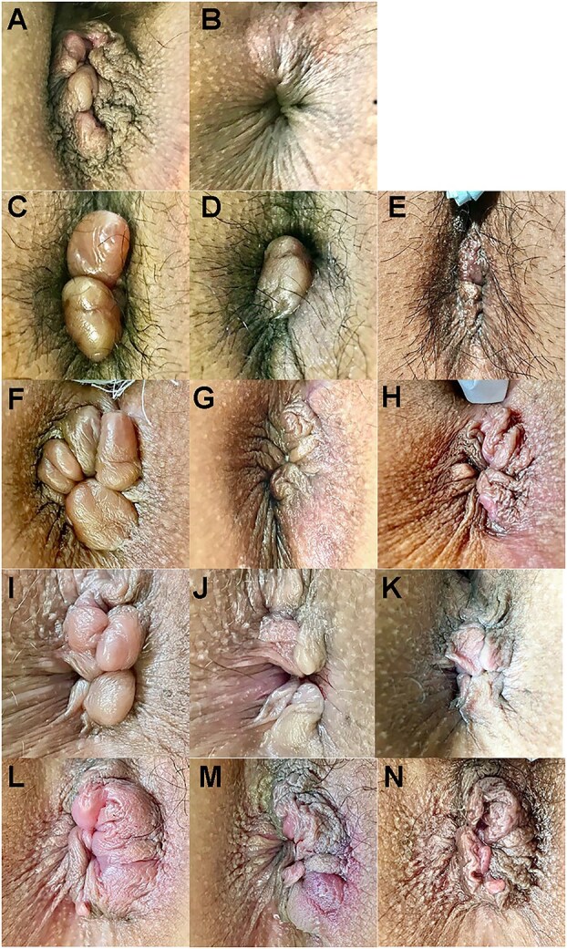 High-intensity focused ultrasound rectoanal lifting (HIFU-RAL) for prolapsed hemorrhoids: a case series.