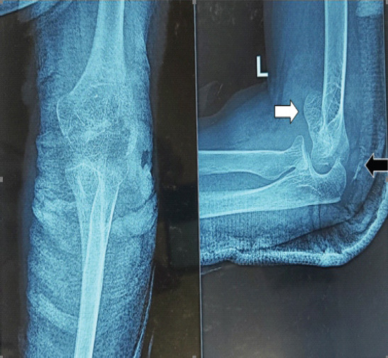 Capitellum Fracture with Distal Triceps Tendon Avulsion Injury: A Rare Presentation with Literature Review.
