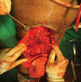 Successful Management of Quadriceps Tendon Tear with Repair and Augmented with Semitendinosus Graft -A Case Series.