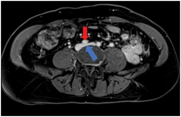 New daily persistent headache with May-Thurner physiology and spinal epidural venous congestion: treatment with ascending lumbar vein embolization.