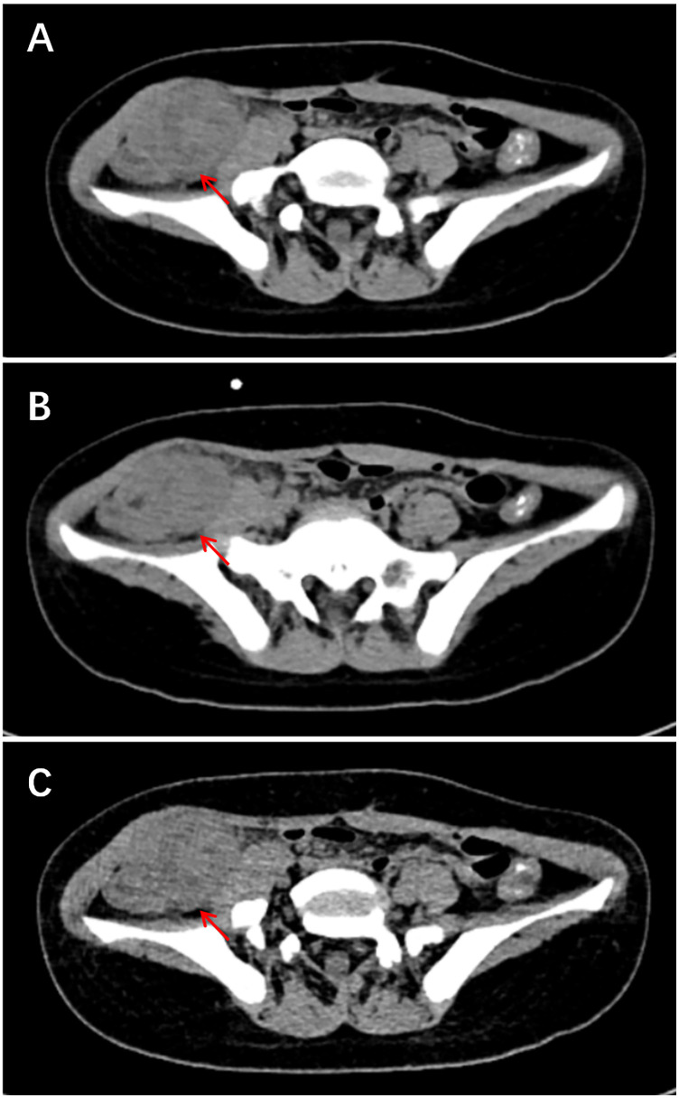 Inflammatory myofibroblastic tumors in children: a single-center retrospective study of clinical features, management, and outcomes.