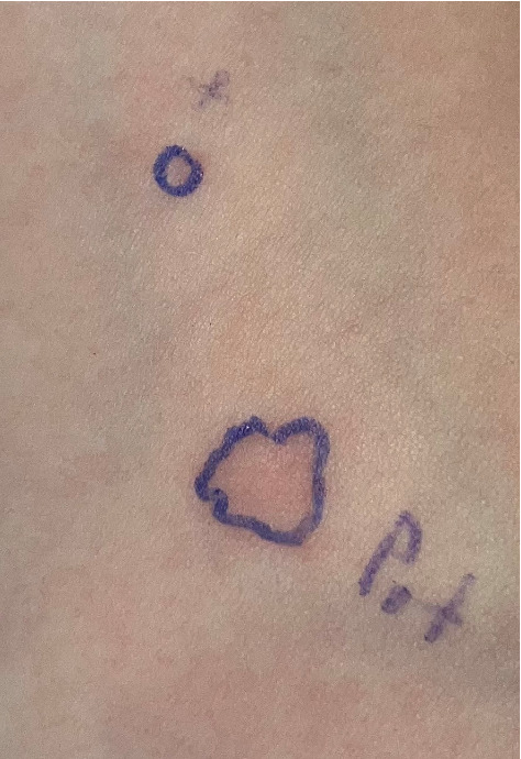 A Case Report of Potato Allergy With Atypical Manifestations in a 2-Year-Old Child.