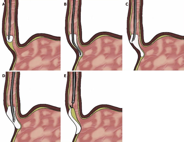 Peroral endoscopic myotomy in children with achalasia: A review of the literature.