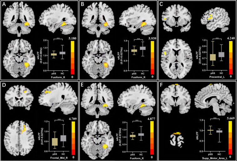 Frequency-dependent and temporal variability of low-frequency fluctuations in patients with primary Sjögren's syndrome.