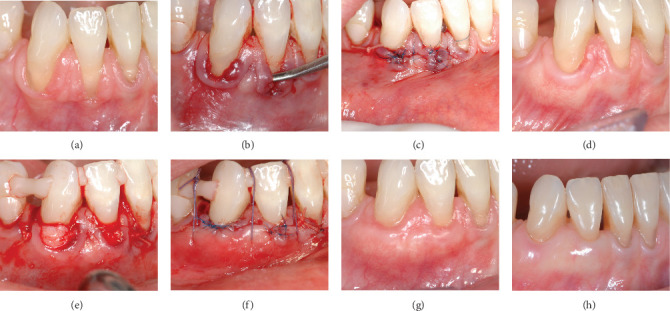 Retreatment of Gingival Recessions: Rationale and Definition Case Series Follow-Up.
