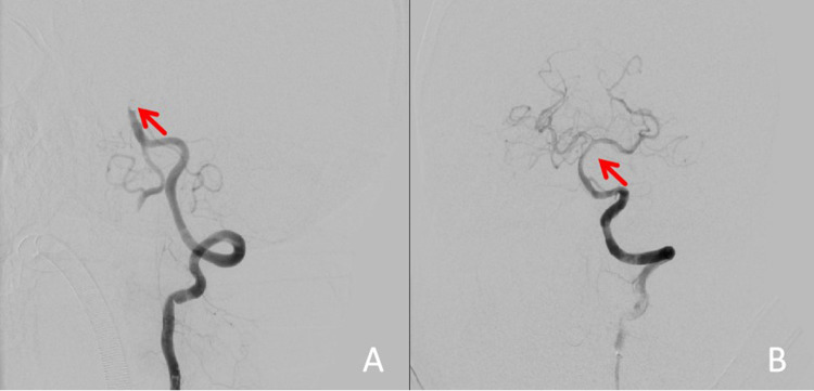 Bilateral Oculomotor Nerve Palsy: A Rare Complication of Bridging Thrombolysis for Acute Basilar Artery Occlusion.