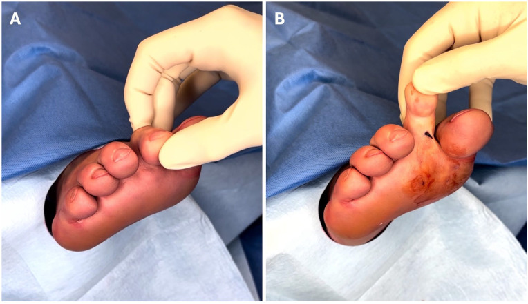Minimally Invasive Plantar Capsule Release and Flexor Tenotomy for Rigid Diabetic Hammer Toe: A Technique Tip.