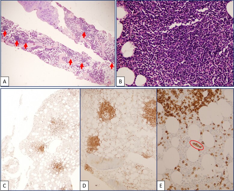 A hidden clue behind angioedema in an elderly patient.
