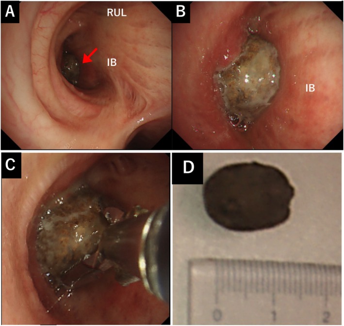 A Case of Bronchial Foreign Body Aspiration Caused by Inhaling a Mukago (Edible Yam Bulbil) Presenting With Persistent Cough.
