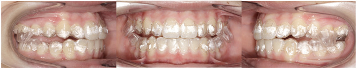 Soft tissue evaluation of functional therapy in growing patients with class II malocclusion: mandibular advancement vs. twin block-a retrospective study.