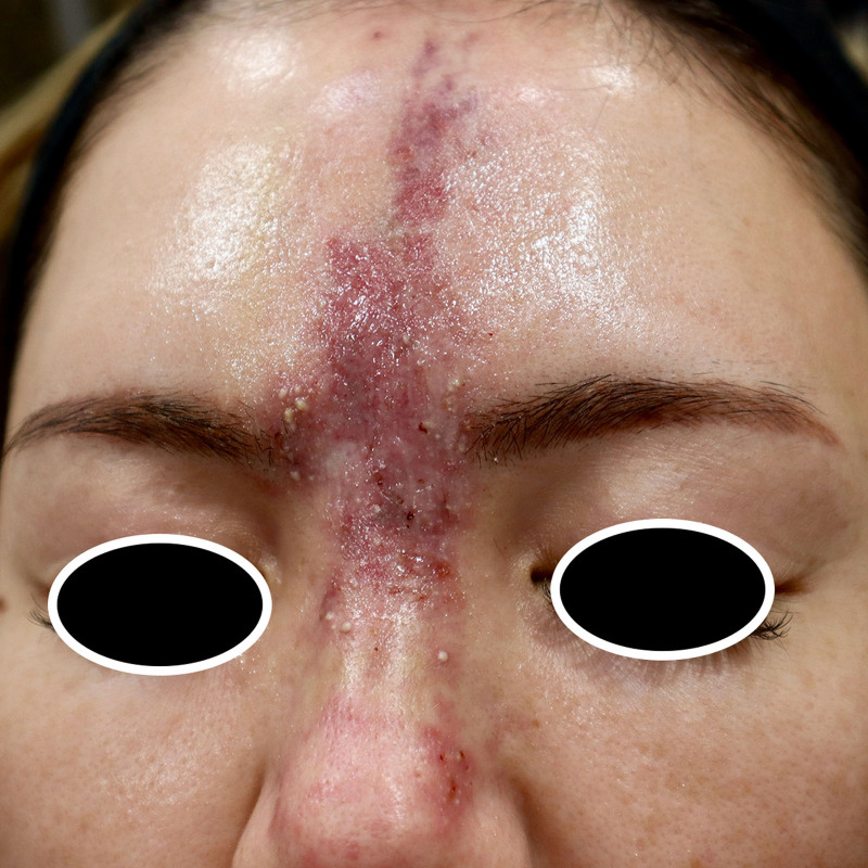 Late Intervention Yet Successful Outcome with High-dose Pulsed Hyaluronidase for Forehead Filler Vascular Complication.