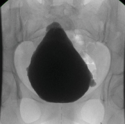 Urofacial Syndrome, an Expressive and Unmasking Sign of Voiding Dysfunction: Case Report and Review of the Literature.