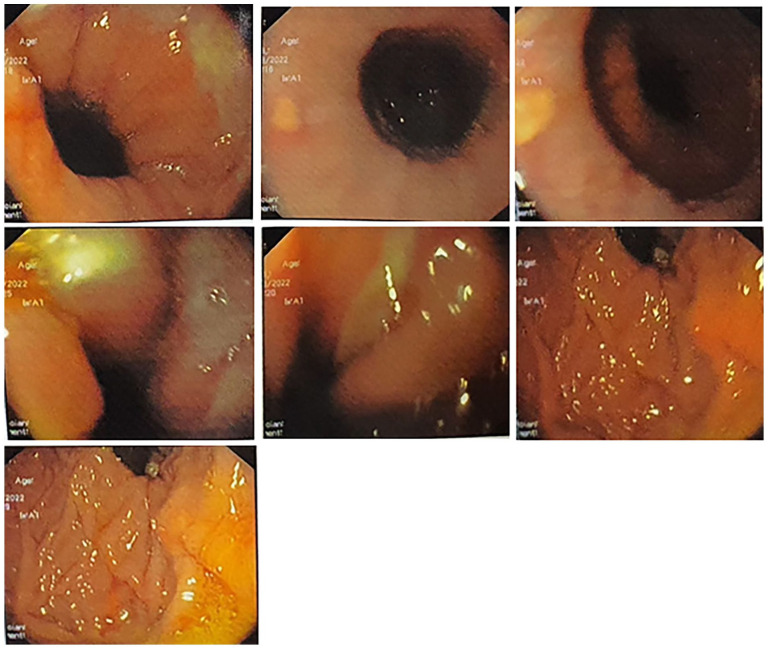Concurrent Hyperparathyroidism and Wilson's Disease in a Patient With Methanol Toxicity: A Rare Case Report.