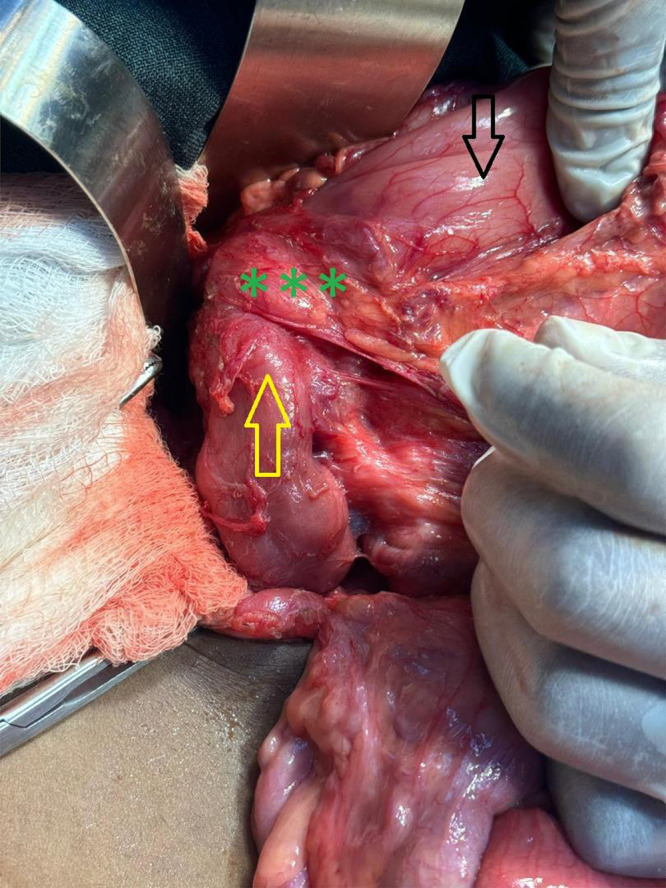 Annular Pancreas in a 13-Year-Old Boy: A Delayed Clinical Presentation of a Congenital Anomaly Highlighting Challenges of Diagnosis.