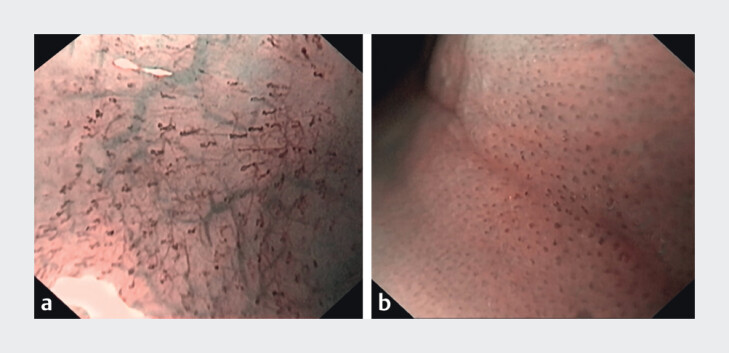 Narrow band imaging complements eosinophilic esophagitis reference score in predicting inflammatory infiltration in patients with dysphagia.