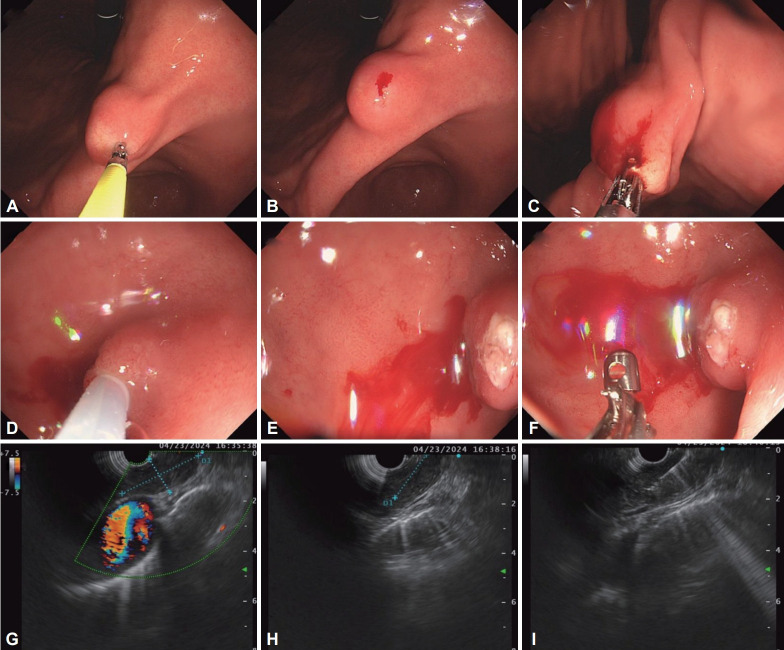 Approach to Gastric Subepithelial Lesions: From Differential Diagnosis to Histologic Confirmation.