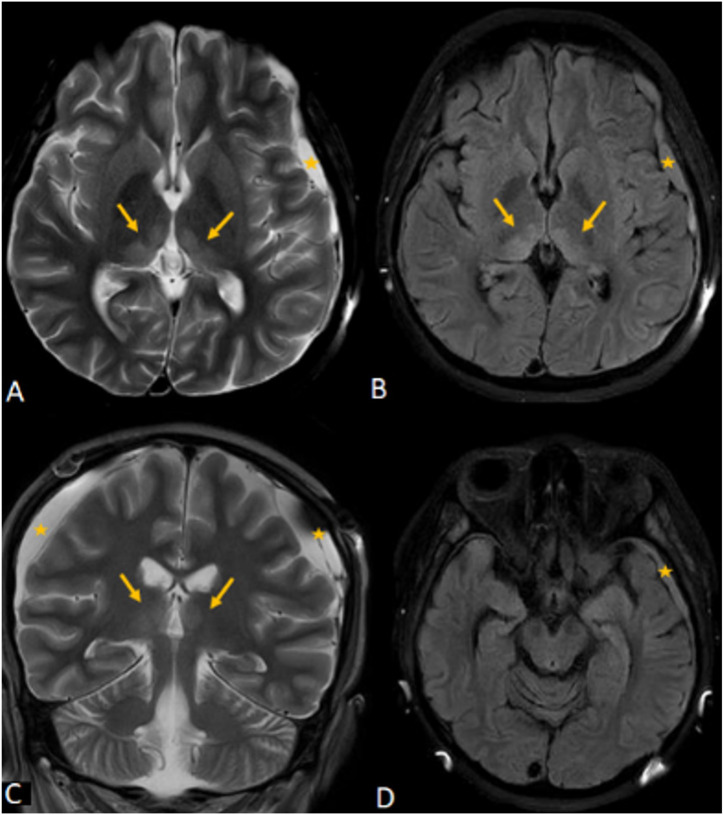Wernicke Encephalopathy Induced by Prolonged Total Parenteral Nutrition in a 16-Year-Old Girl with Acute Myeloid Leukemia.