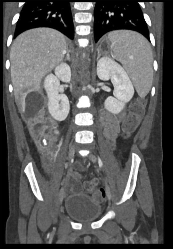 When appendicitis mimics a liver abscess: diagnostic challenges in pediatric surgery.